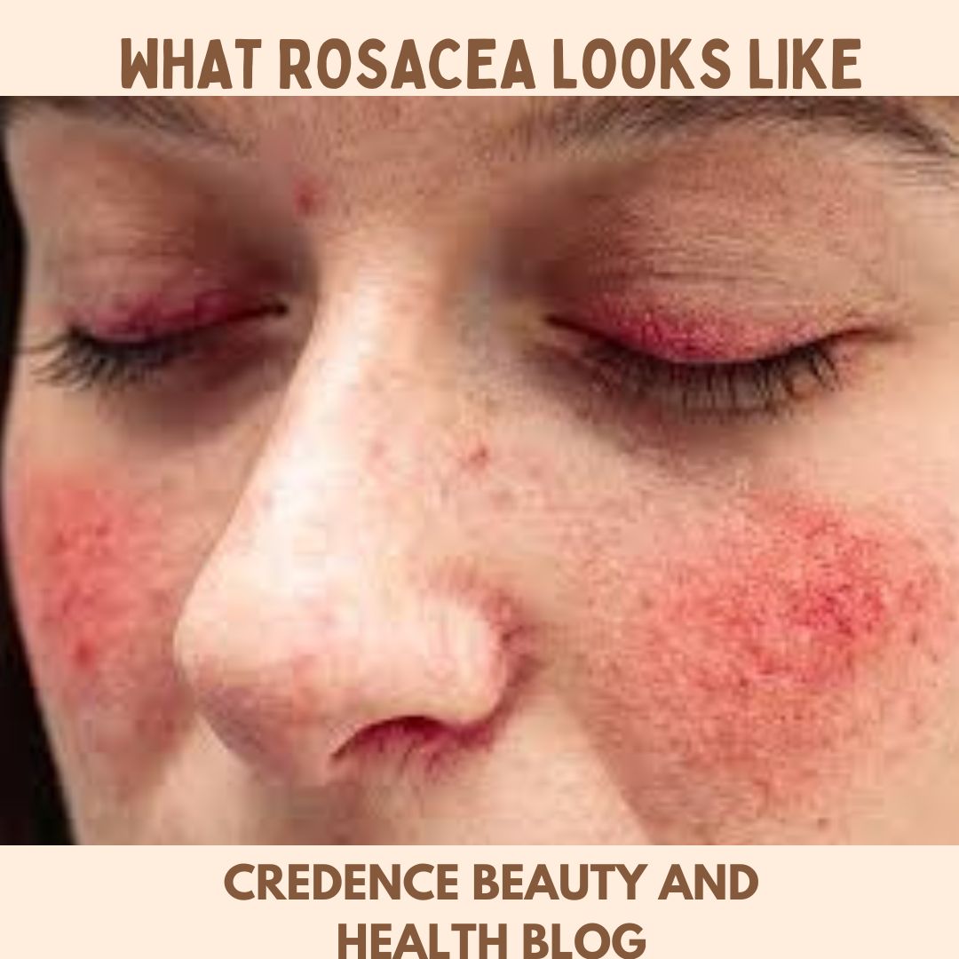 Rosacea Unlocked: Understanding and Managing This Skin Condition