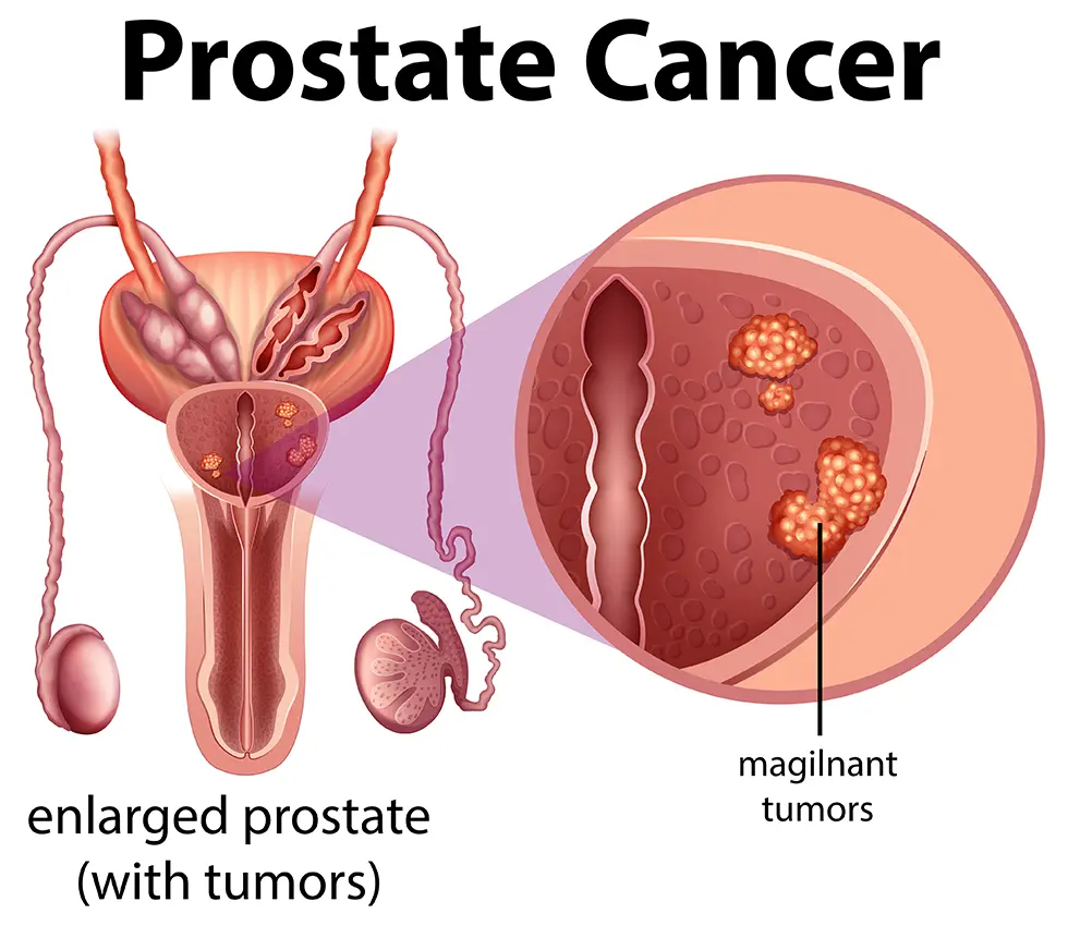 Does poor sex cause prostate cancer in men? – Medical expert