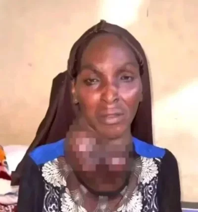 Woman who chose N300,000 cash over operation to remove her goitre is dead