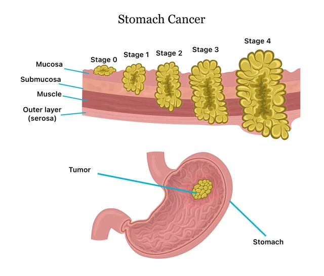 Stomach Cancer: Avoid too much intake of these 3 things if you want to live long