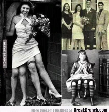 Remember the lady with 4 legs and 2 private organs, who later had 5 kids, here is how it happened