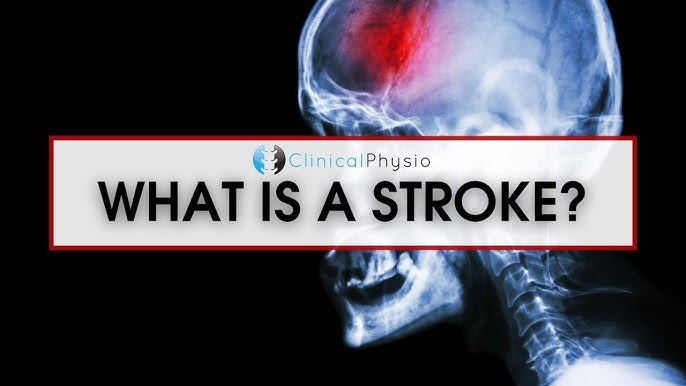 A comprehensive guide to reducing the risk of stroke