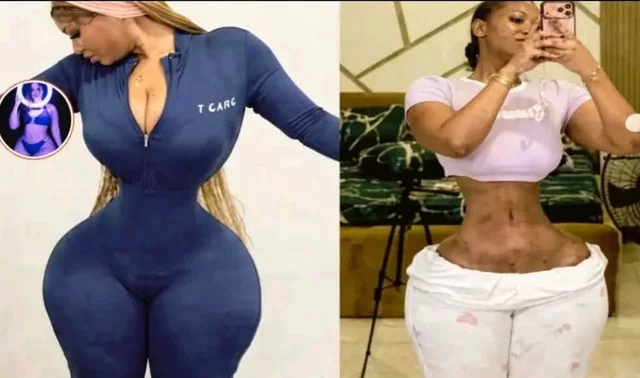Plastic Surgery: Woman who allegedly removed 20 ribs now suffering from BBL leakage (Video)